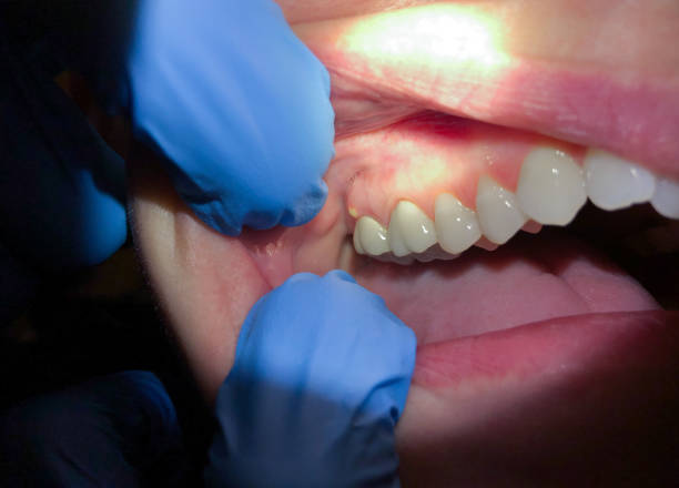 Best Emergency Care for Gum Disease in Rossvle, IL