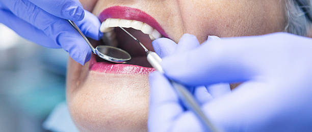 Best Knocked-Out Tooth (Avulsed Tooth) Treatment in Rossvle, IL